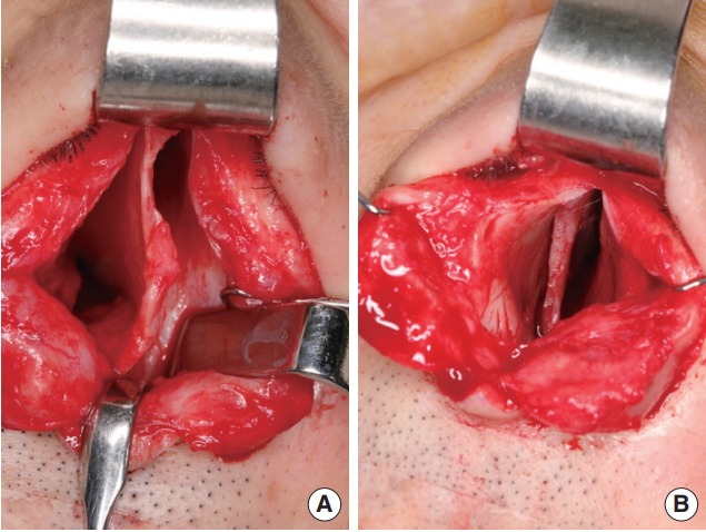 Persistent curved deformity after septoplasty and more chondrotomy to relieve deforming forces of the bony septum