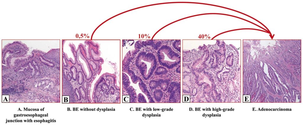 Histopathologic features of the natural history of Barrett’s esophagus (BE)
