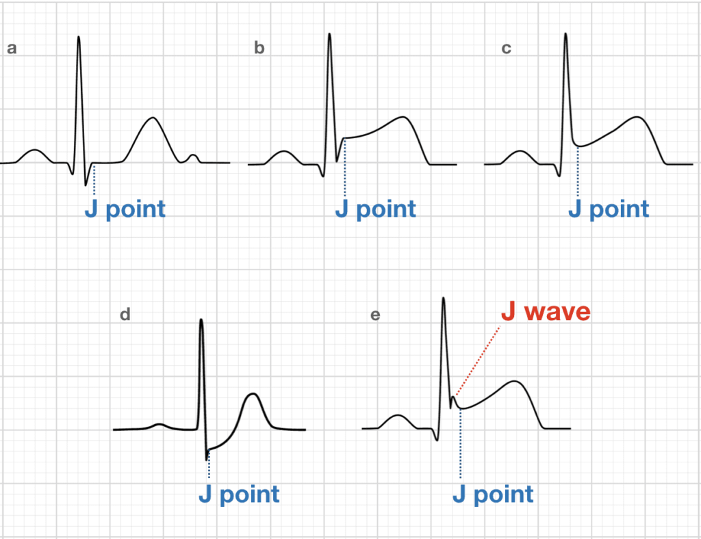 J point & wave in ECG