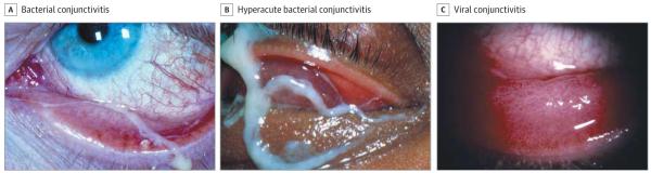 Characteristic Appearance of Bacterial and Viral Conjunctivitis