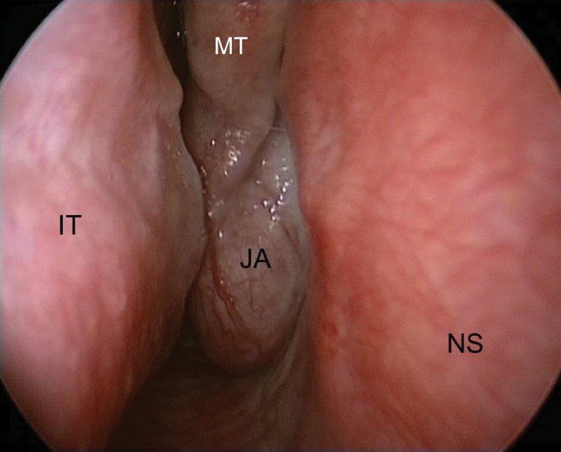 Endoscopic view of the right nasal fossa. Juvenile angiofibroma (JA) obstructing the nasal cavity and protruding between the middle turbinate (MT) and the nasal septum (NS)