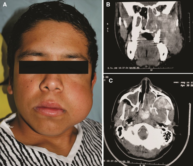 14-year-old male with a tumoral mass affecting the nasopharynx and extending into left cheek