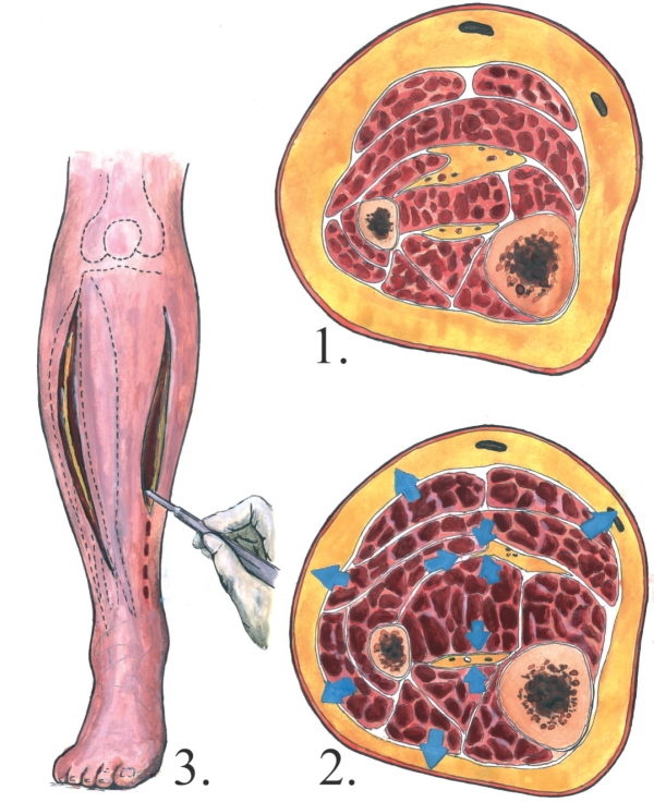 Compartment syndrome and fasciotomy incisions