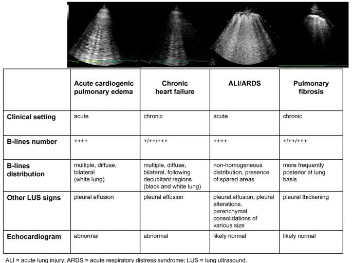 Different etiologies of interstitial syndrome by lung ultrasound (LUS)